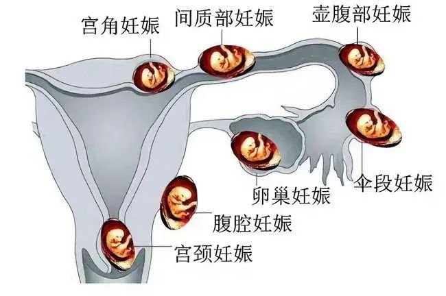 深圳试管婴儿选性别费用发布2024助孕价格参考